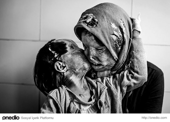 29 yaşındaki Somayeh Mehri ve 3 yaşındaki kızı Rana Afghanipour birbirlerini öperken. Asit saldırısına maruz kaldıktan sonra, kimsenin onları öpmek istemediğini söylüyorlar.